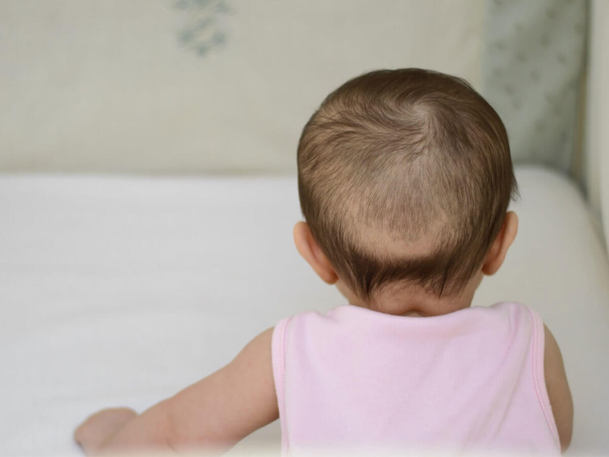 [LƯU Ý] Cách chữa rụng tóc vành khăn ở trẻ. Trẻ bị rụng tóc vành khăn nên uống gì?
