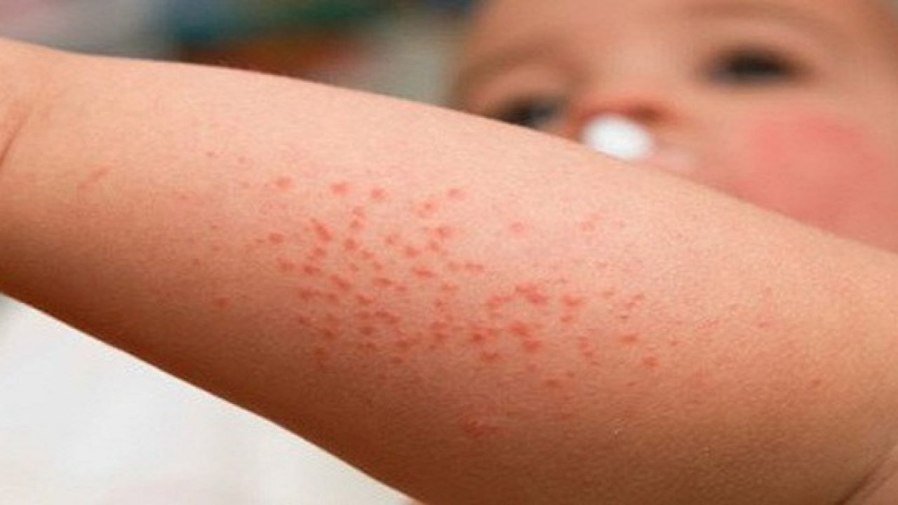 Hình ảnh bệnh sốt xuất huyết ở trẻ em 1