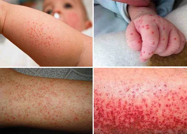 Hình ảnh bệnh sốt xuất huyết ở trẻ em 4