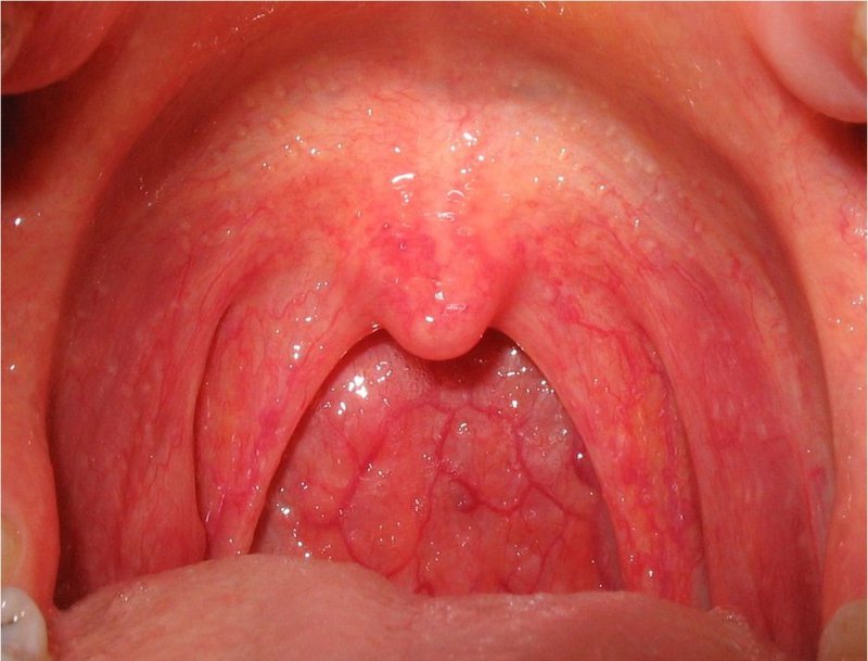Viêm họng xuất tiết bội nhiễm là gì và cách điều trị? 1
